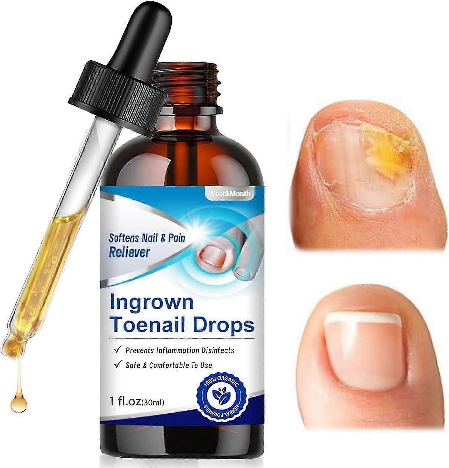 1-3Pcs Ingrown Toenail Drops, Ingrown Toenail Treatment, Cuticle Care Oil For Ingrown Toenails, Extra Strength Nail Repair Solution