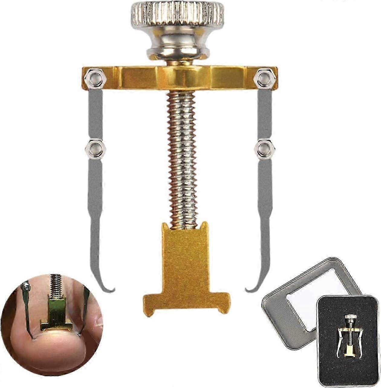 Ingegroeide teennagelcorrectie