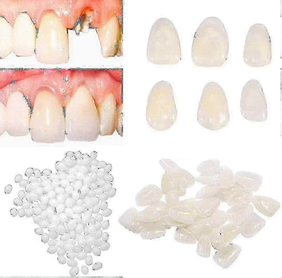 Temporary Tooth Kit For Filling The Missing Tooth And Gaps-moldable Fake Teeth And Beads Replacement Kit