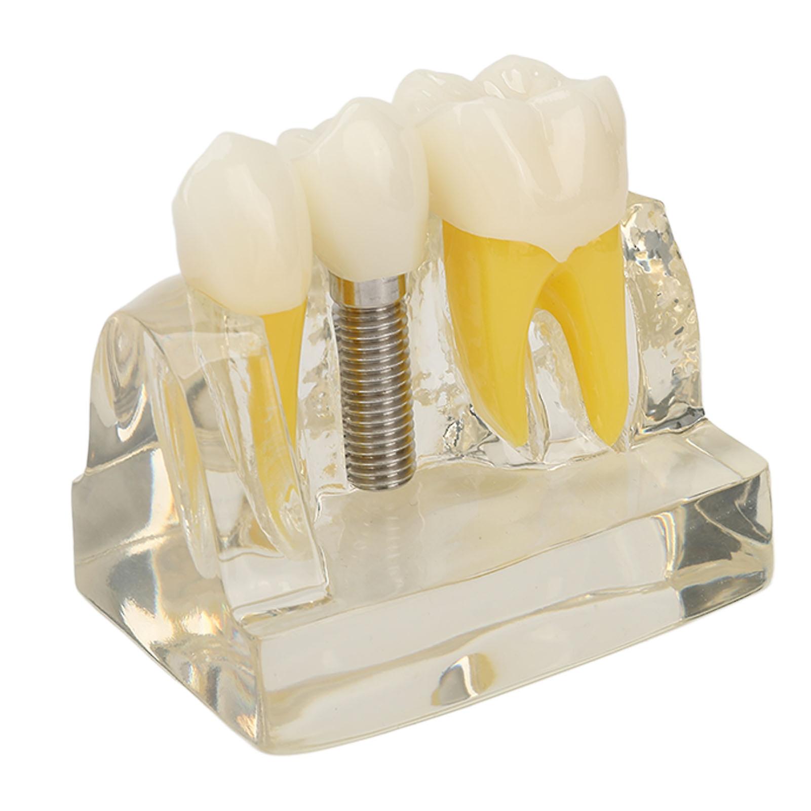 Teeth Implant Model Transparent Resin Dental Teaching Demonstration