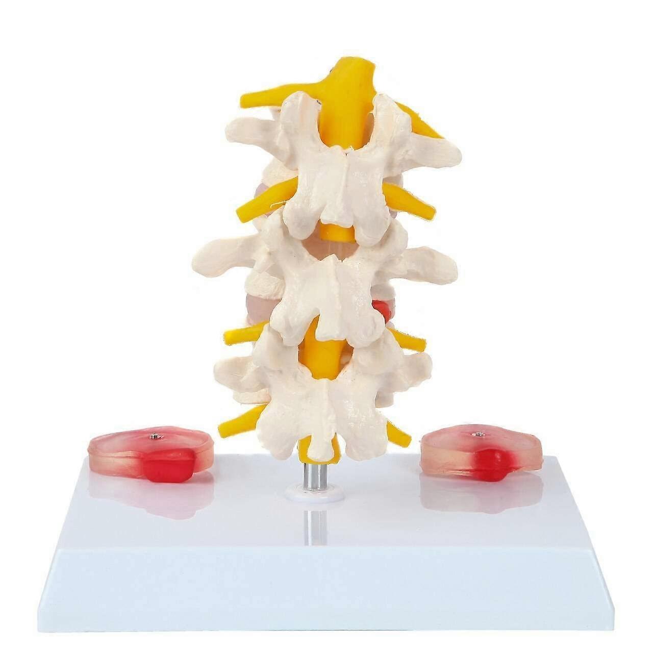 Lumbar Vertebrae with Prolapsed Discs