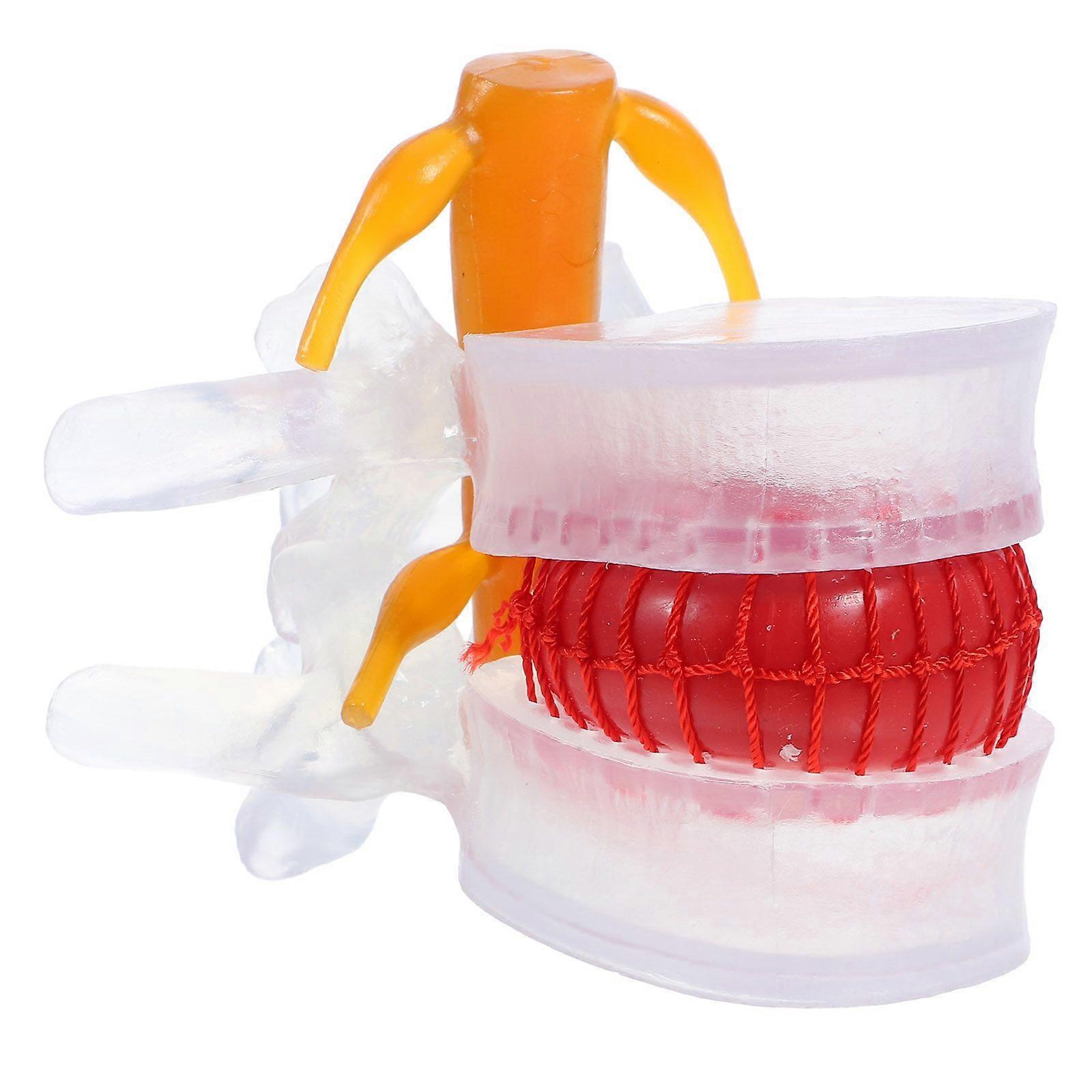 Human Lumbar Disc Herniation Model Demonstration Human Lumbar Spine Model for Students