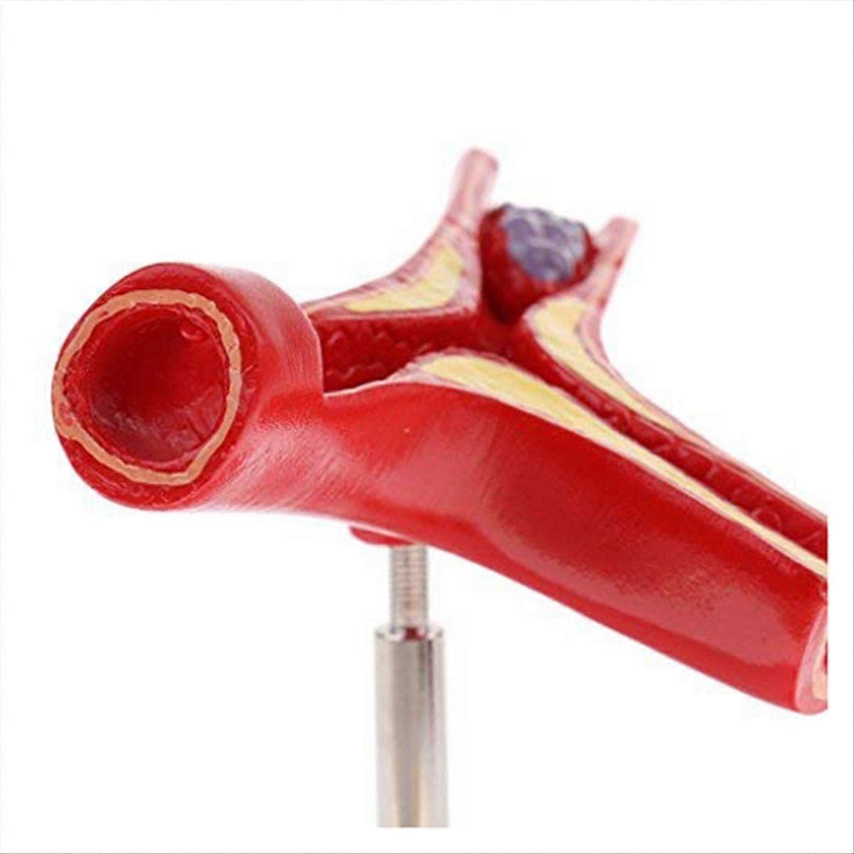 Human Atherosclerosis Cardiovascular Model