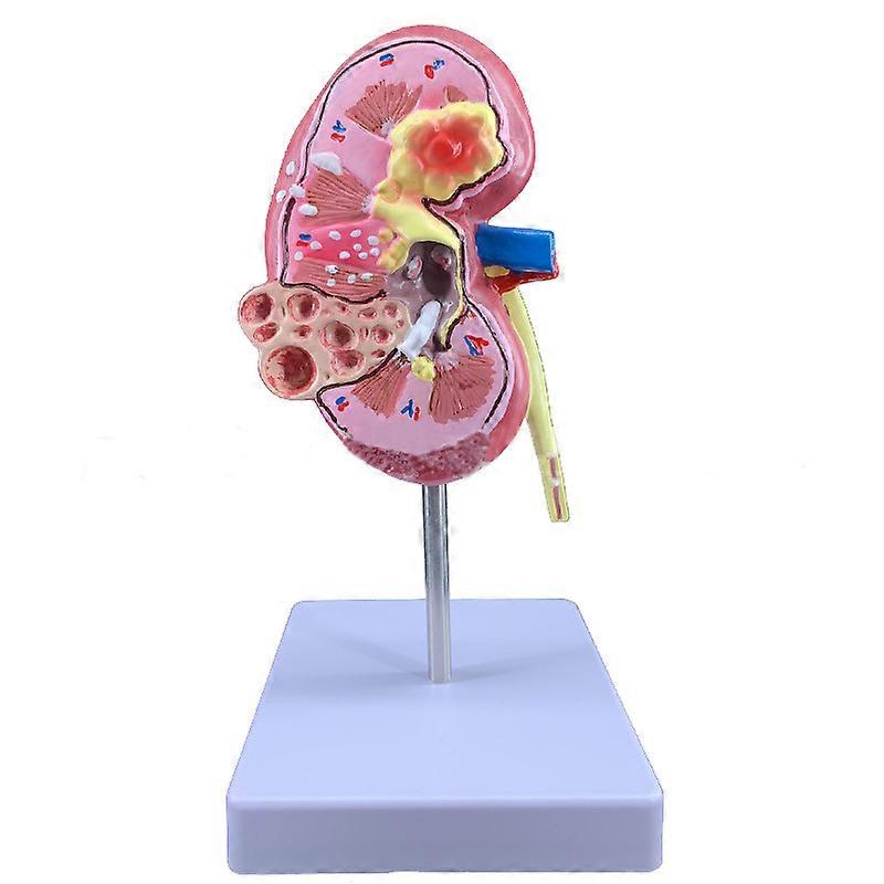 Teaching simulation diseased kidney model human body model teaching aids