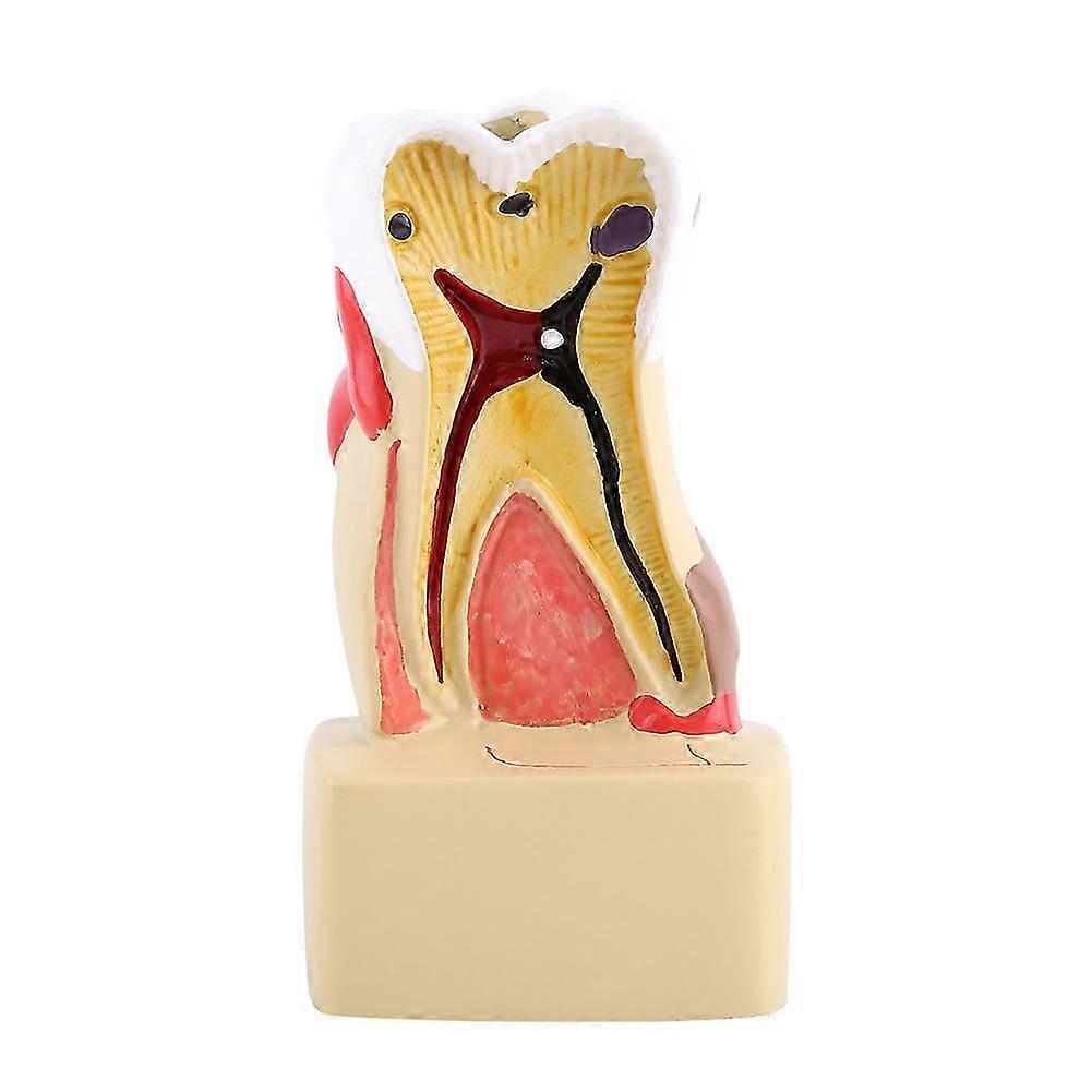 2025 1pc Dental Comprehensive Pathological Disease Caries Study Teaching Tooth Model