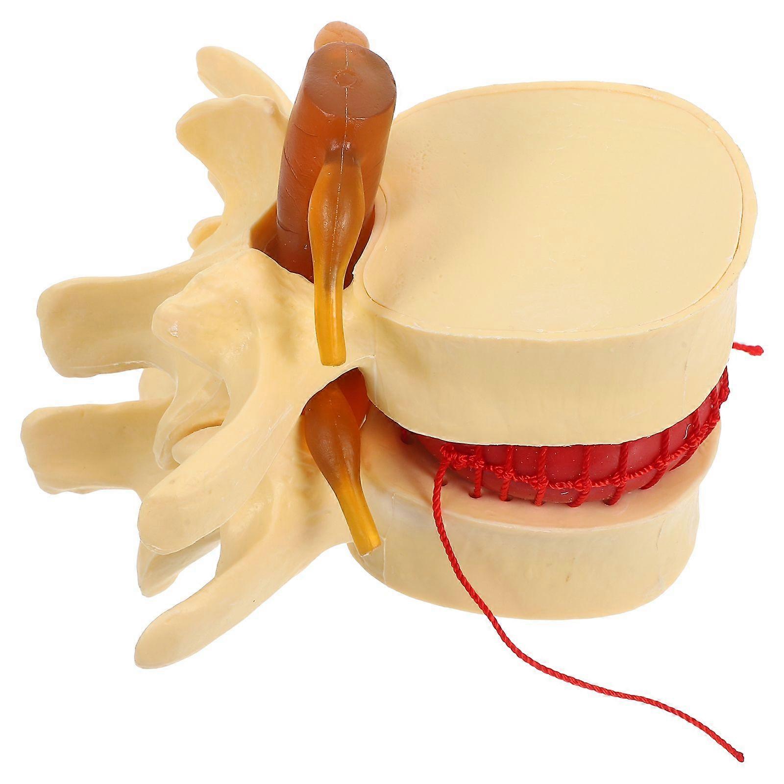 Spine Model for Anatomy: Human Anatomical Lumbar Disc Herniation Model - Portable Lumbar Vertebrae Disc Prop for Teaching and Learning