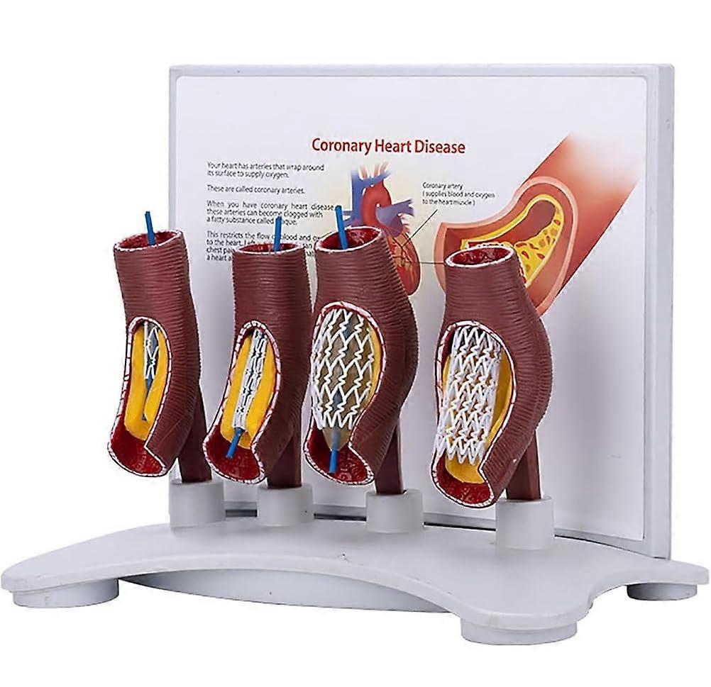Human Coronary Stent Model for Training, Vascular Stent Model with Clear Vessel Visualization