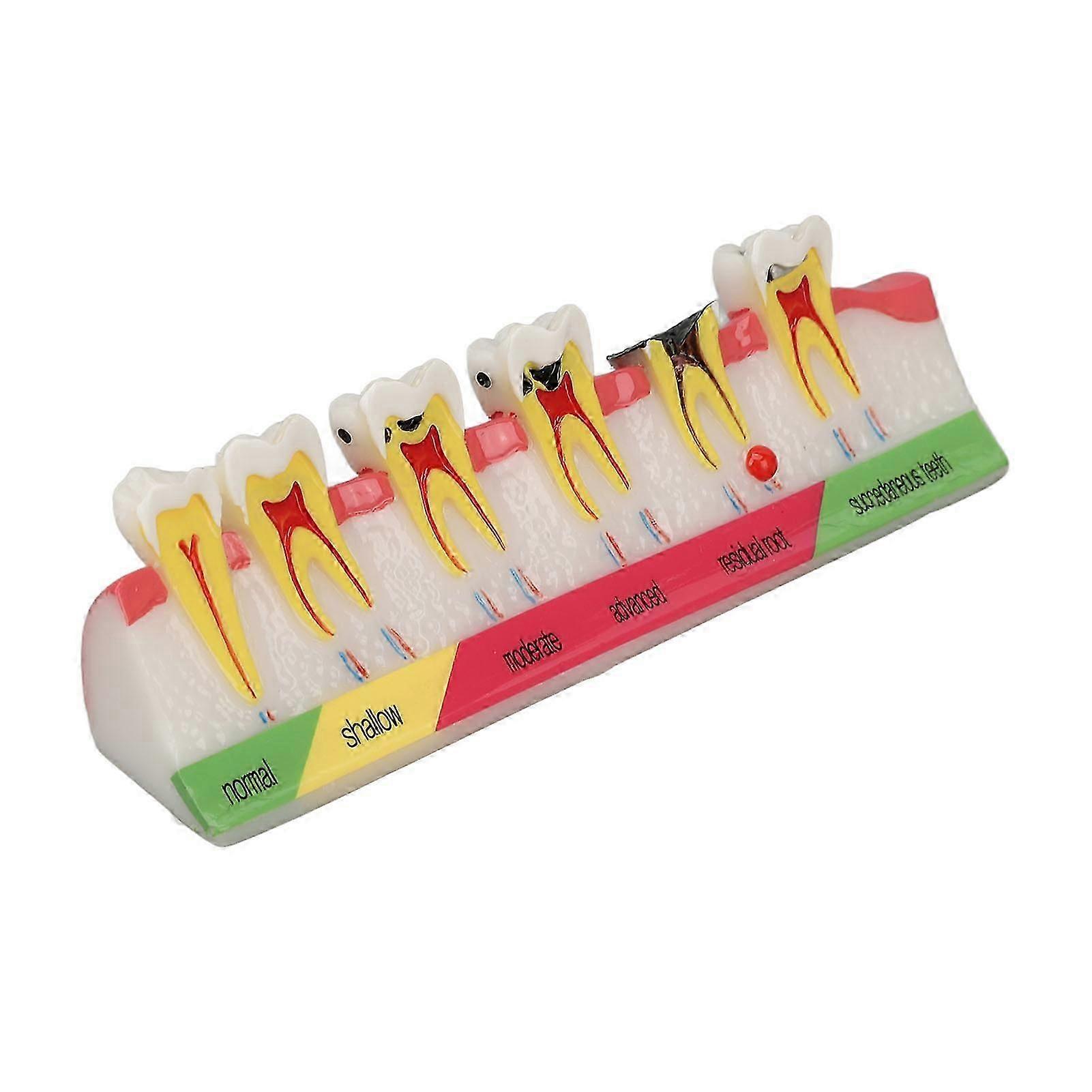 Dental Caries Model 6 Different Stages Resin Decayed Tooth Display Model