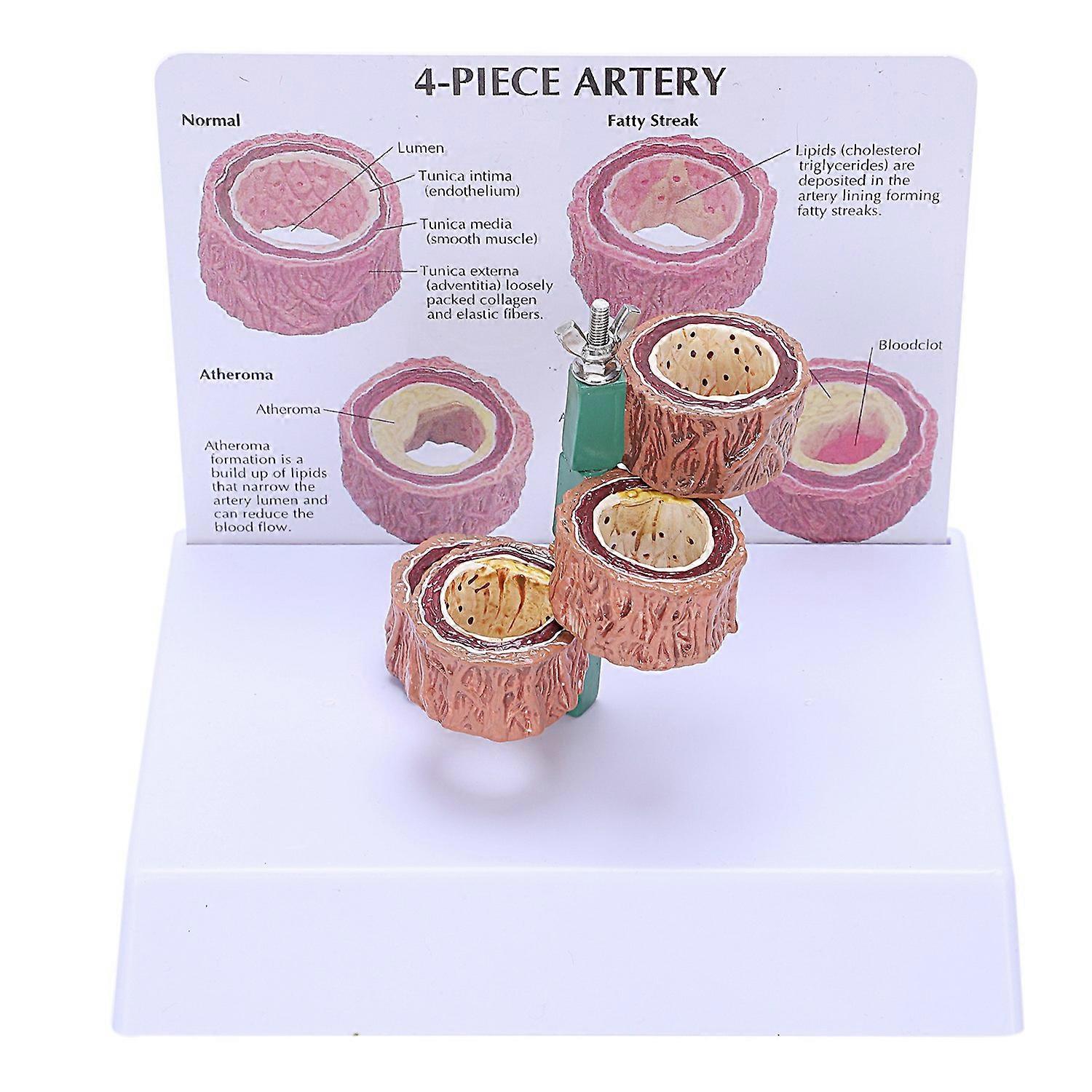 Atherosclerosis Thrombosis Vascular Disease Demonstration Heart Vascular Pathology