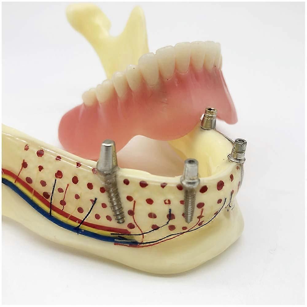 Dental Implant Model with Clear Implant Visualization, Lower Jaw Teeth Study and Durable Teaching Display