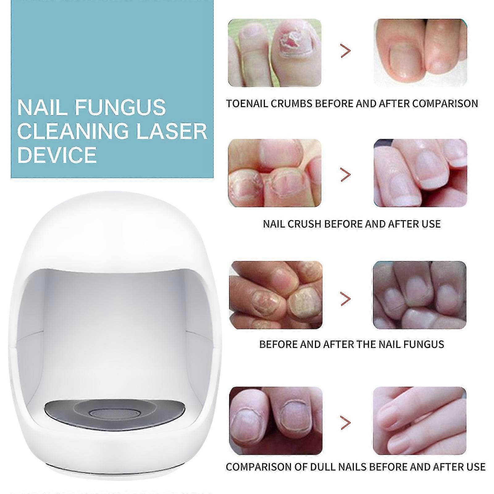Nagelsvamp Rengöring Laserbehandlingsanordning, Nagelsvampbehandling För tånaglar Fingernagel, Smärtfri nagelsvamp Laserbehandling Tw
