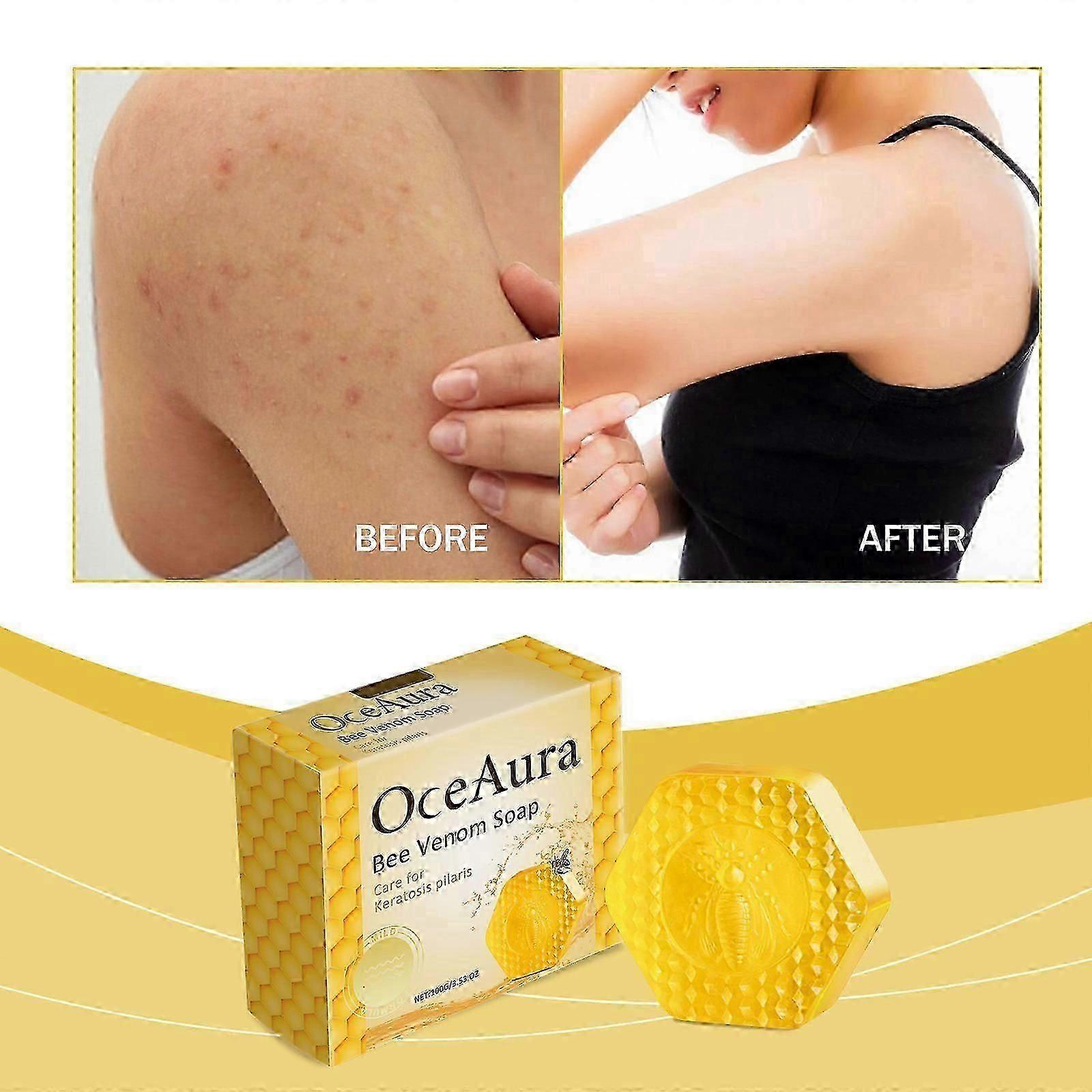 sabonete para queratose pilar com veneno de abelha