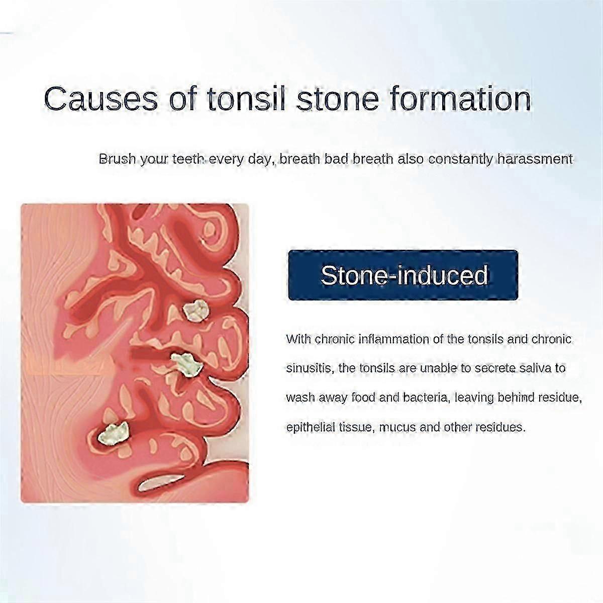Instant Suction Electronic Tonsil Stone Remover Vacuum Kit