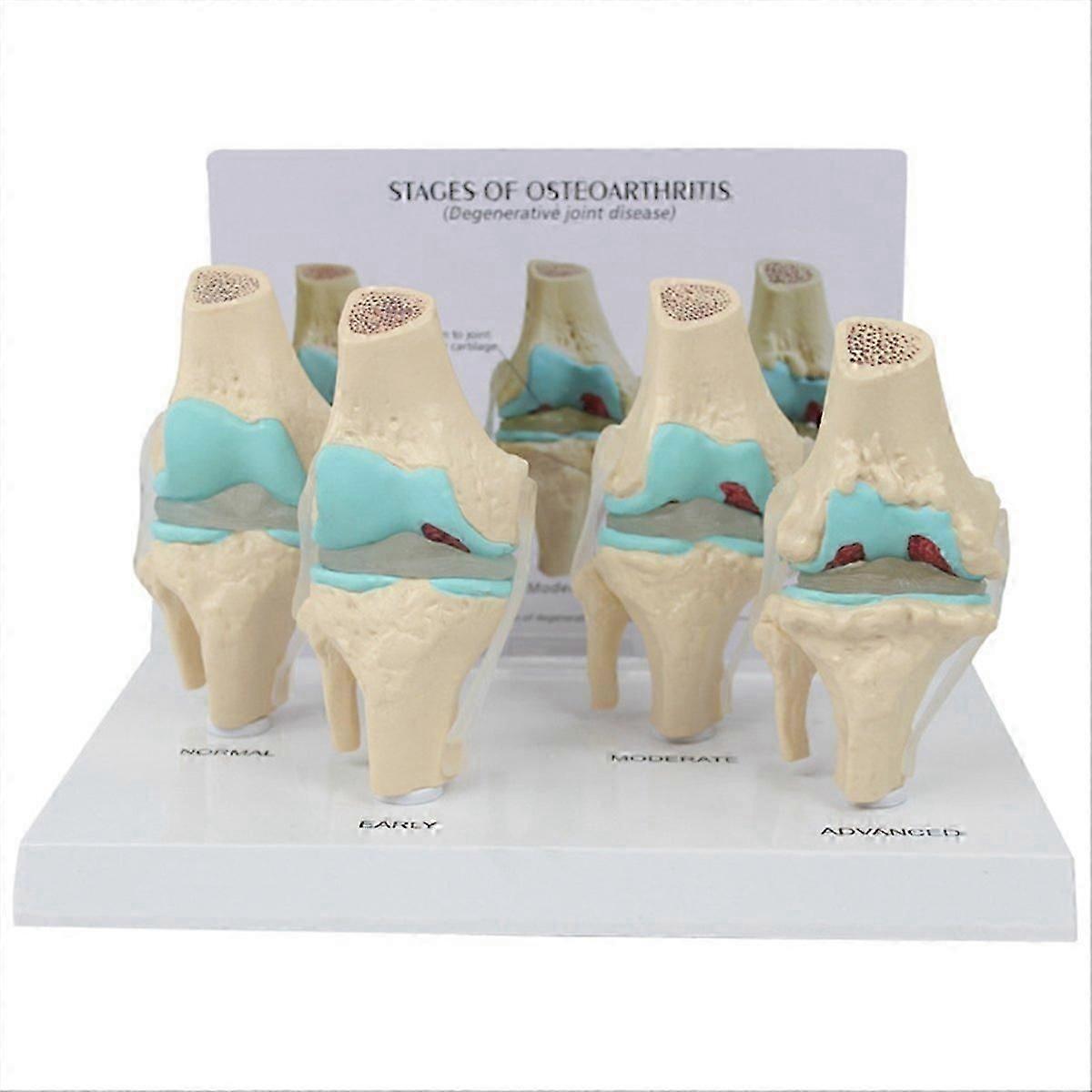 Osteoarthritis Anatomy Model with Educational Key Card 4 Stage