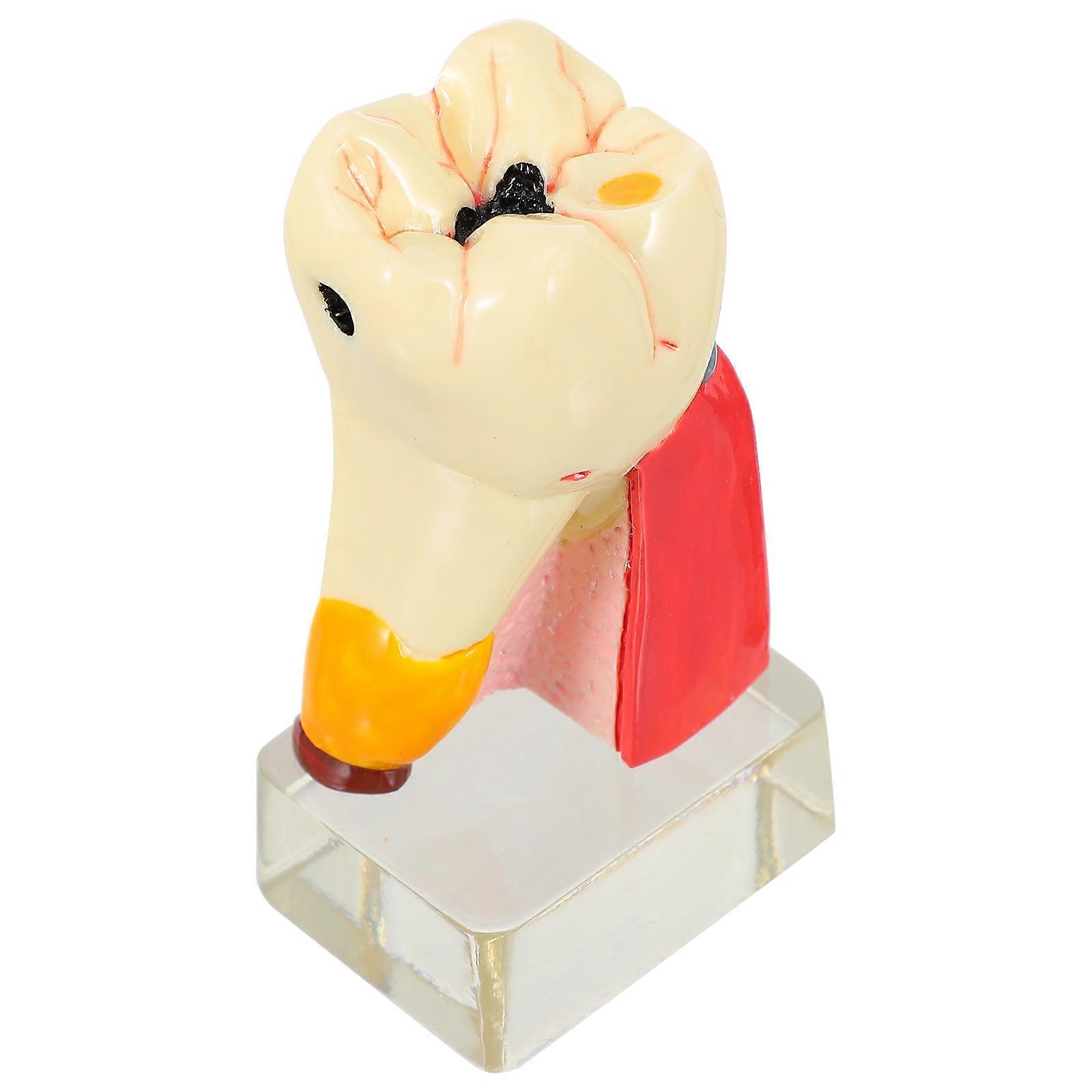 Model Resin Tooth Decay Model for Tool