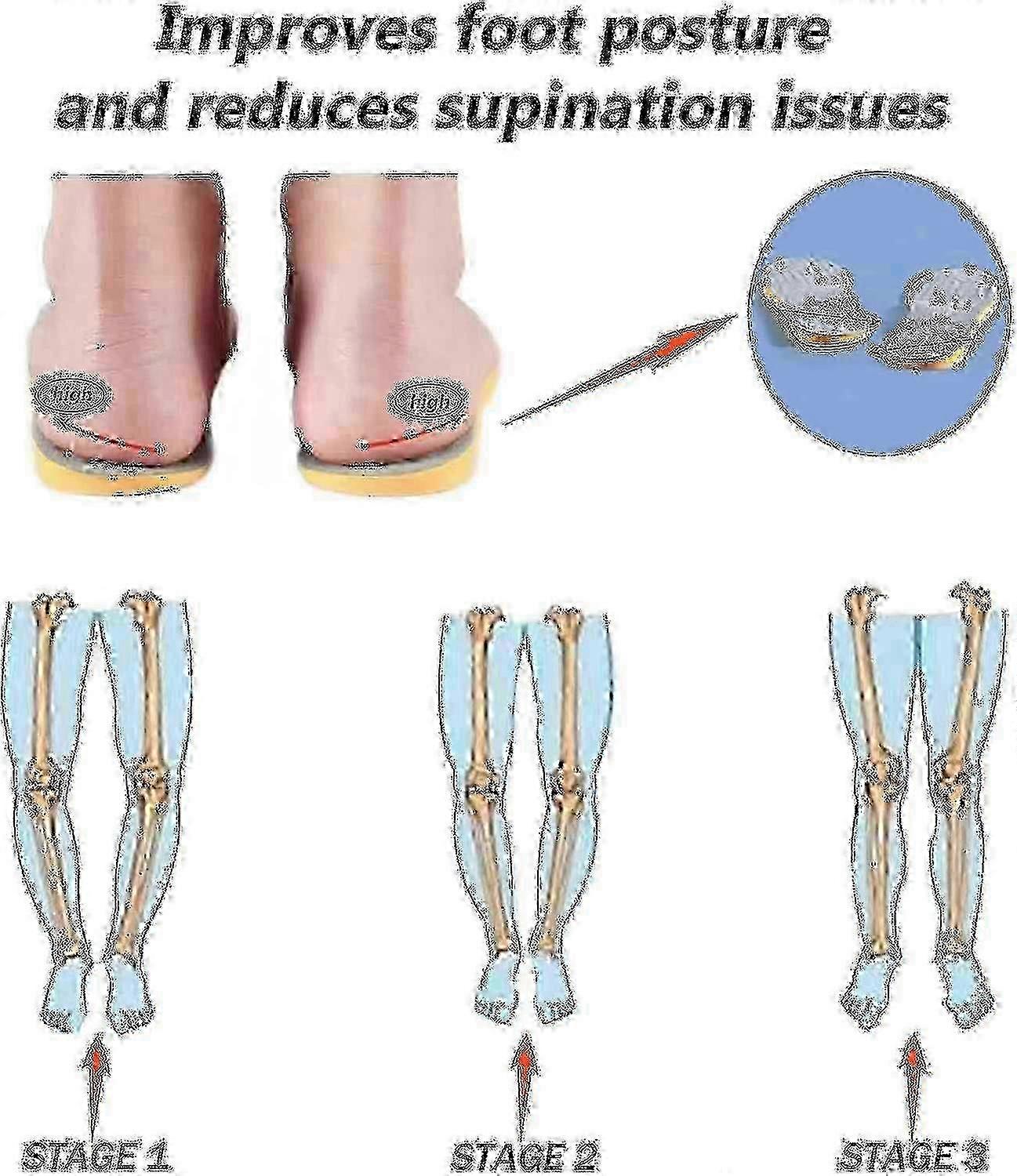 Supination Insoles For Over Supination & High Arch Support,orthotic Inserts For Foot Alignment, Knoc Tw