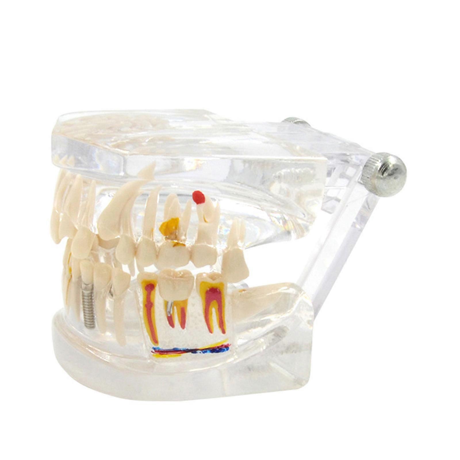 Transparent Dental Implant Model Removable Teeth Portable Disease Teeth Model