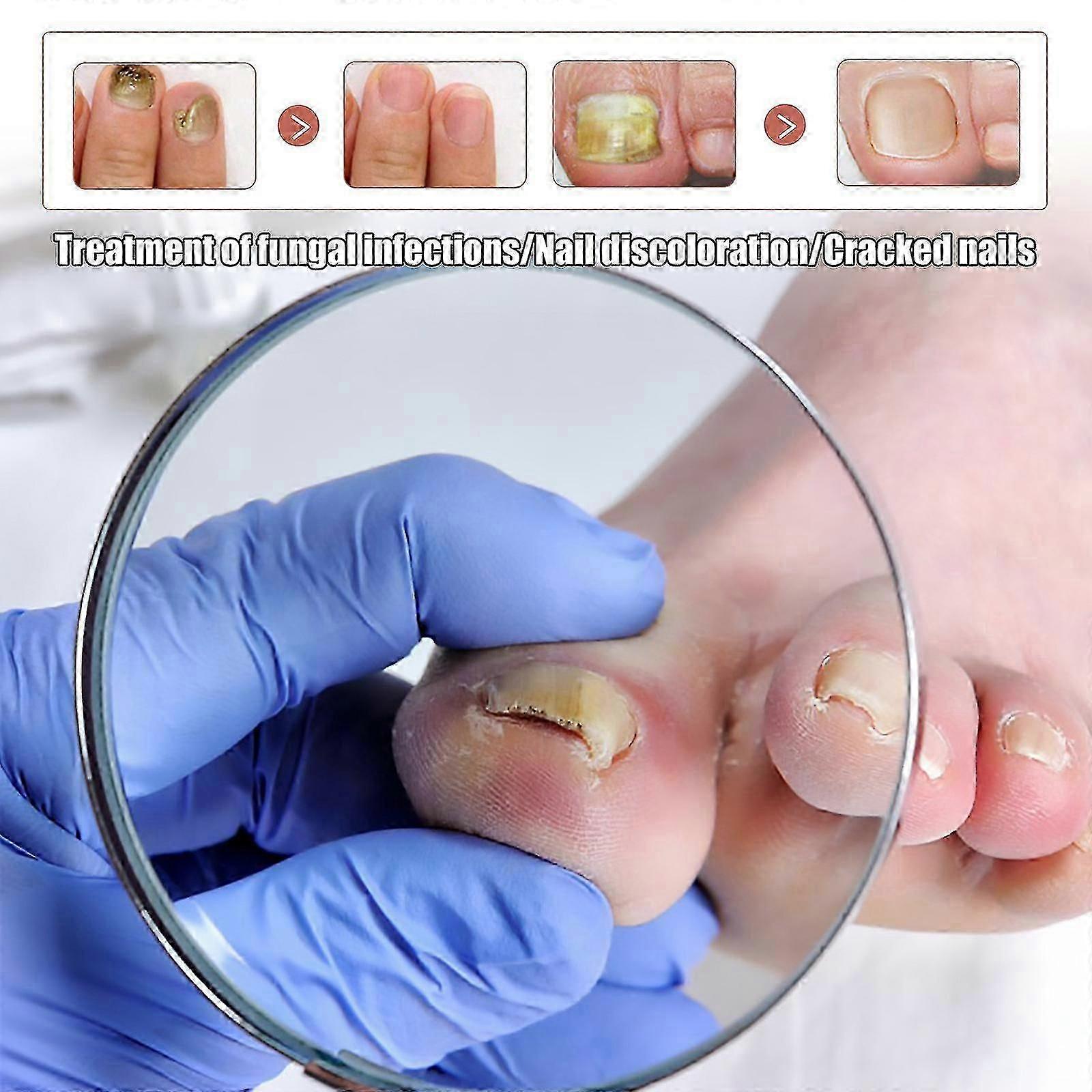 30ml X3 Toenail Repair Liquid Υγρό Καθαρισμού Μαλακών Νυχιών