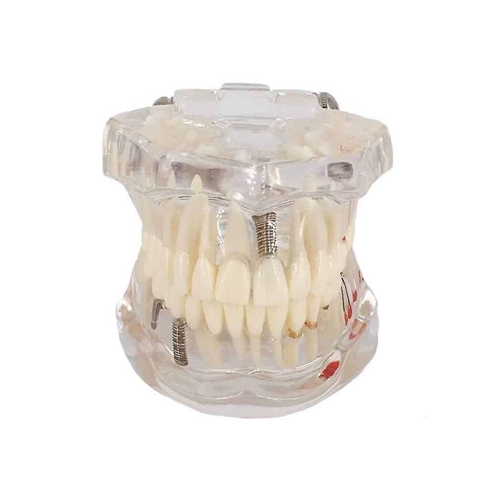 Transparent Disease Dental Implant Teeth Model