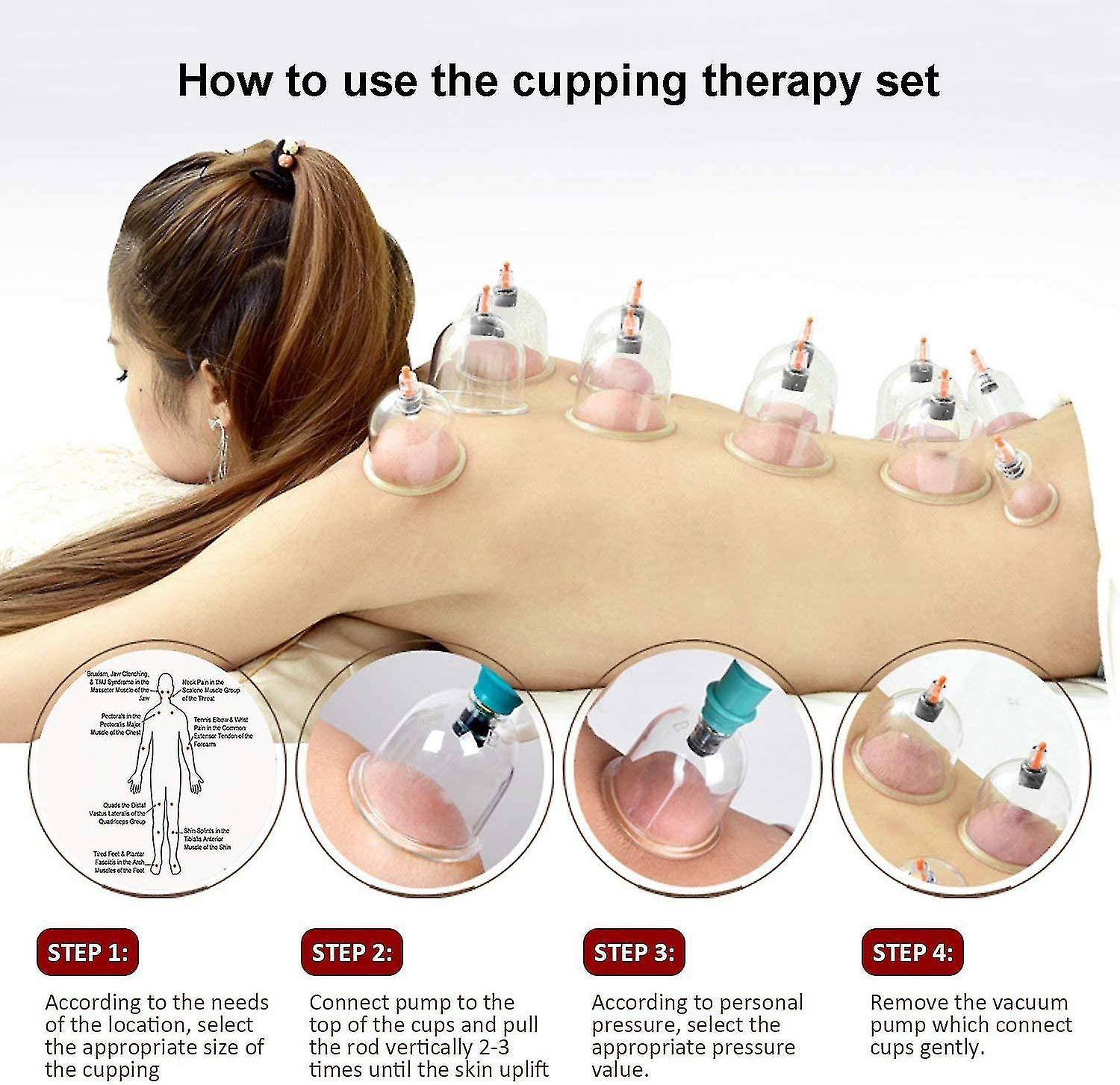 Cupping Terapia Con Ventosas Beneficios De Ventosas En Espalda