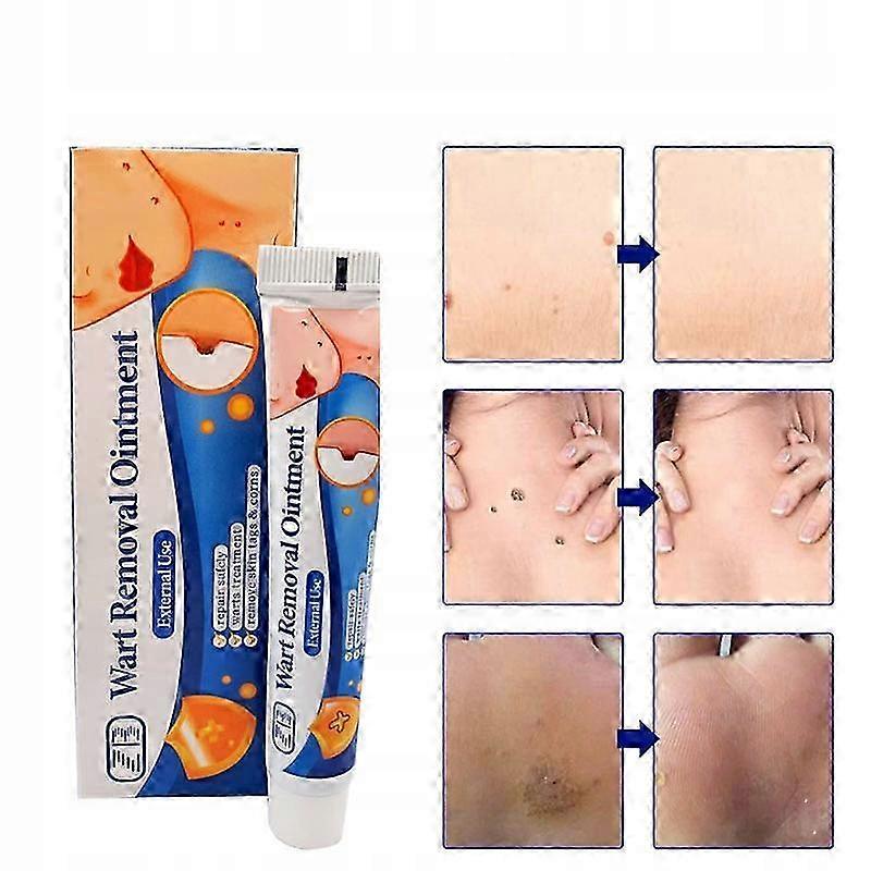 Herbal Extract Ointment for Skin Treatment – Pointed Condylomas Plain Warts Herpes