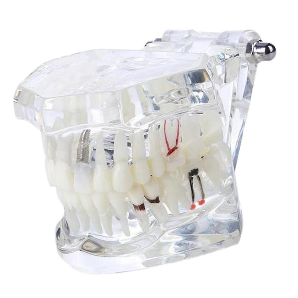 1pc Dental Teeth Model Removable Repair Model Pathology Implanted Model