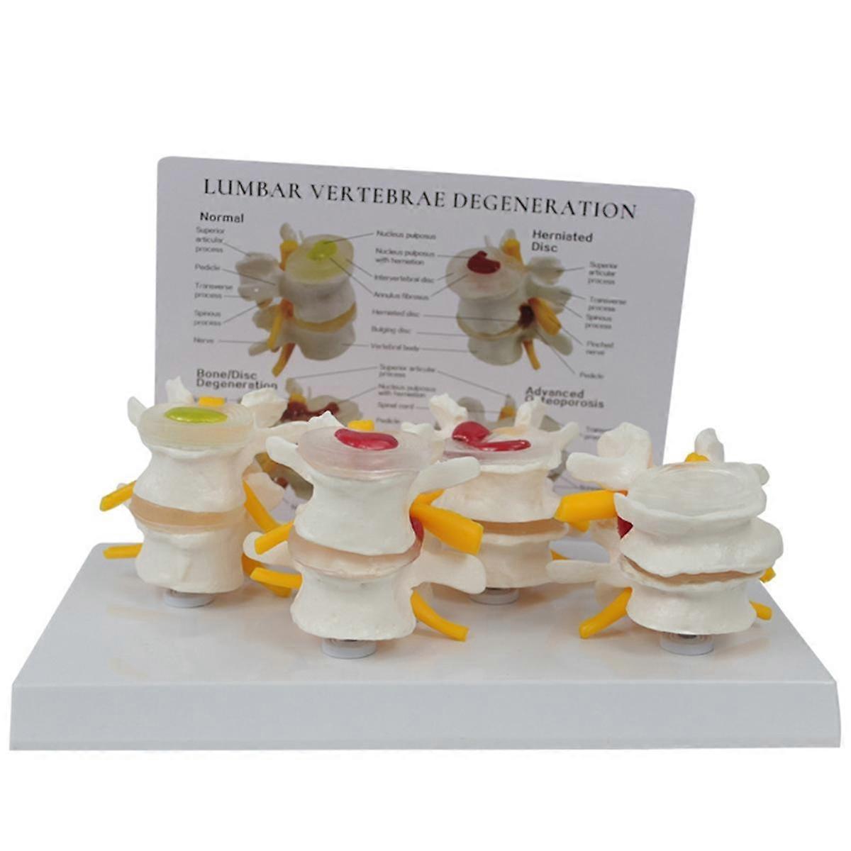 Four Stage Vertebrae Model, Human Anatomy and Physiology Educational Spine Model, Doctor'S Office A