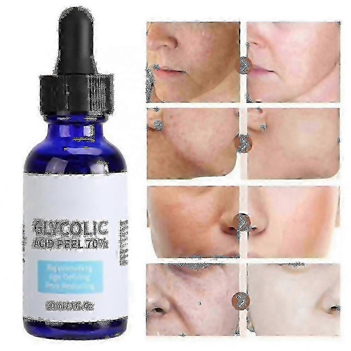 For Glycolic Acid Peel Purity 70 Concentration 5 Skin Repair Invisible Pores Brighten Skin Tone Trea