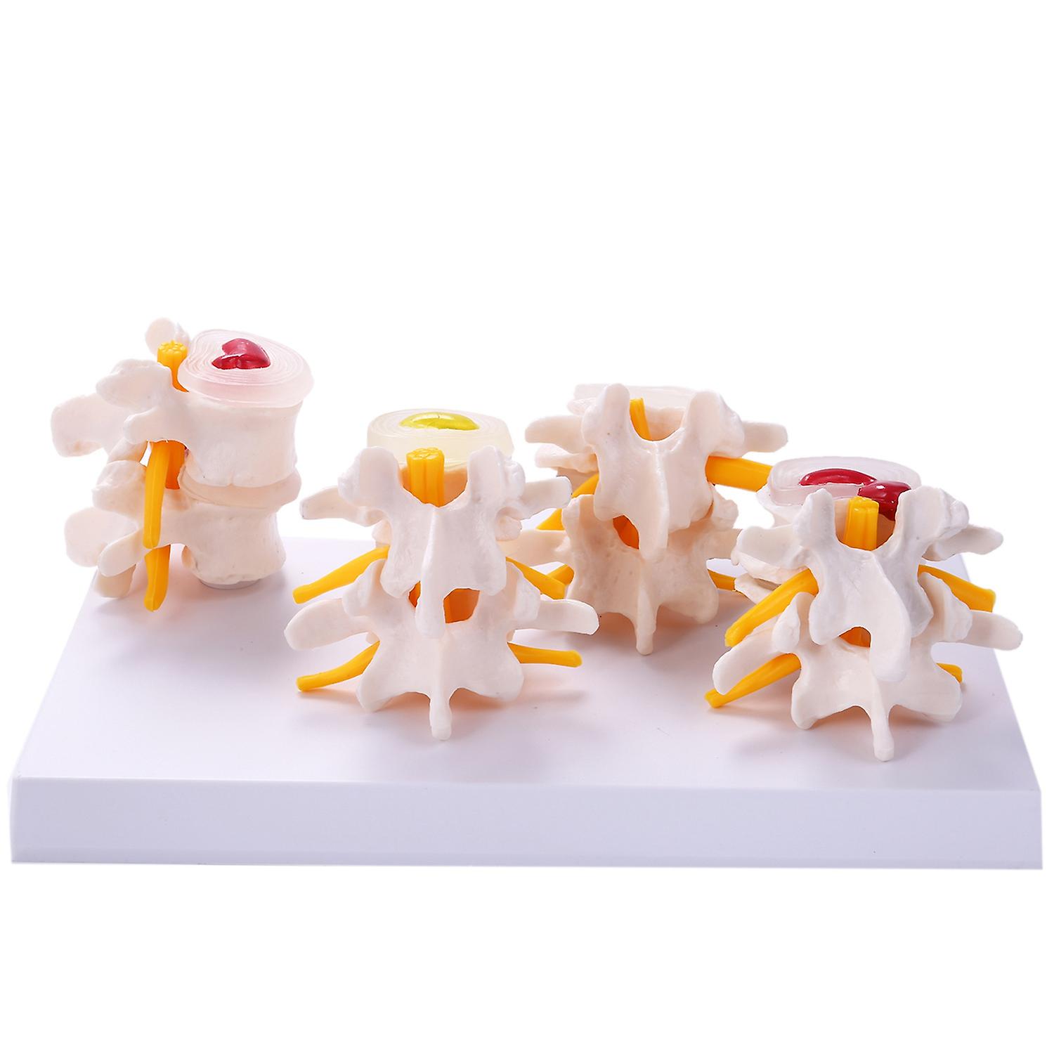 Human Anatomy Skeleton Spine 4-Stages Lumbar Vertebral Skull Traumatic Teaching Supplies