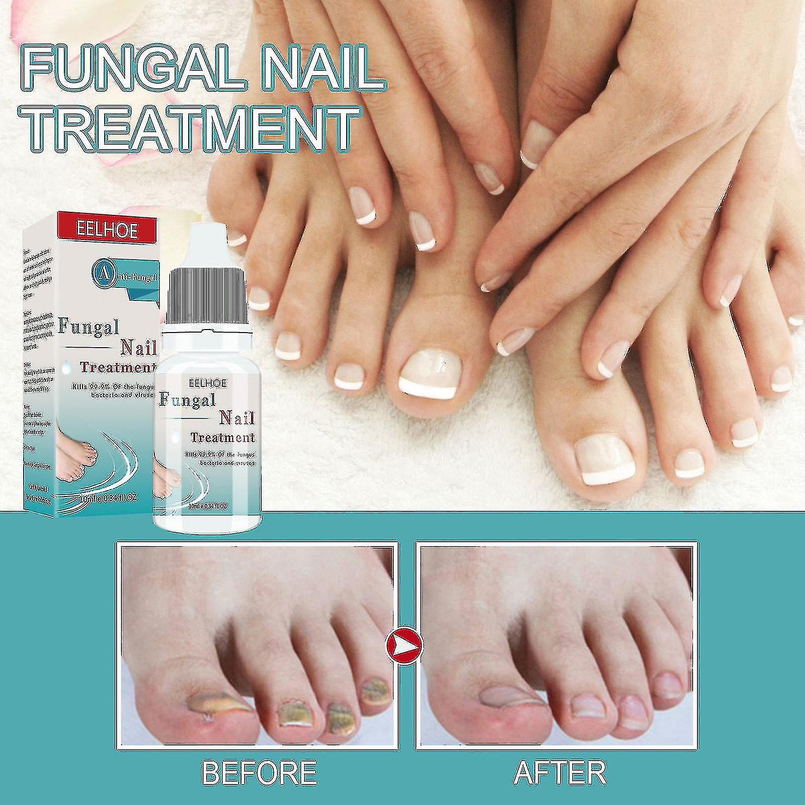 Eelhoe Nail Onycho Liquid Nail Care Solution