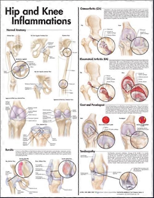 Hip And Knee Inflammations Anatomical Chart Wallchart Book