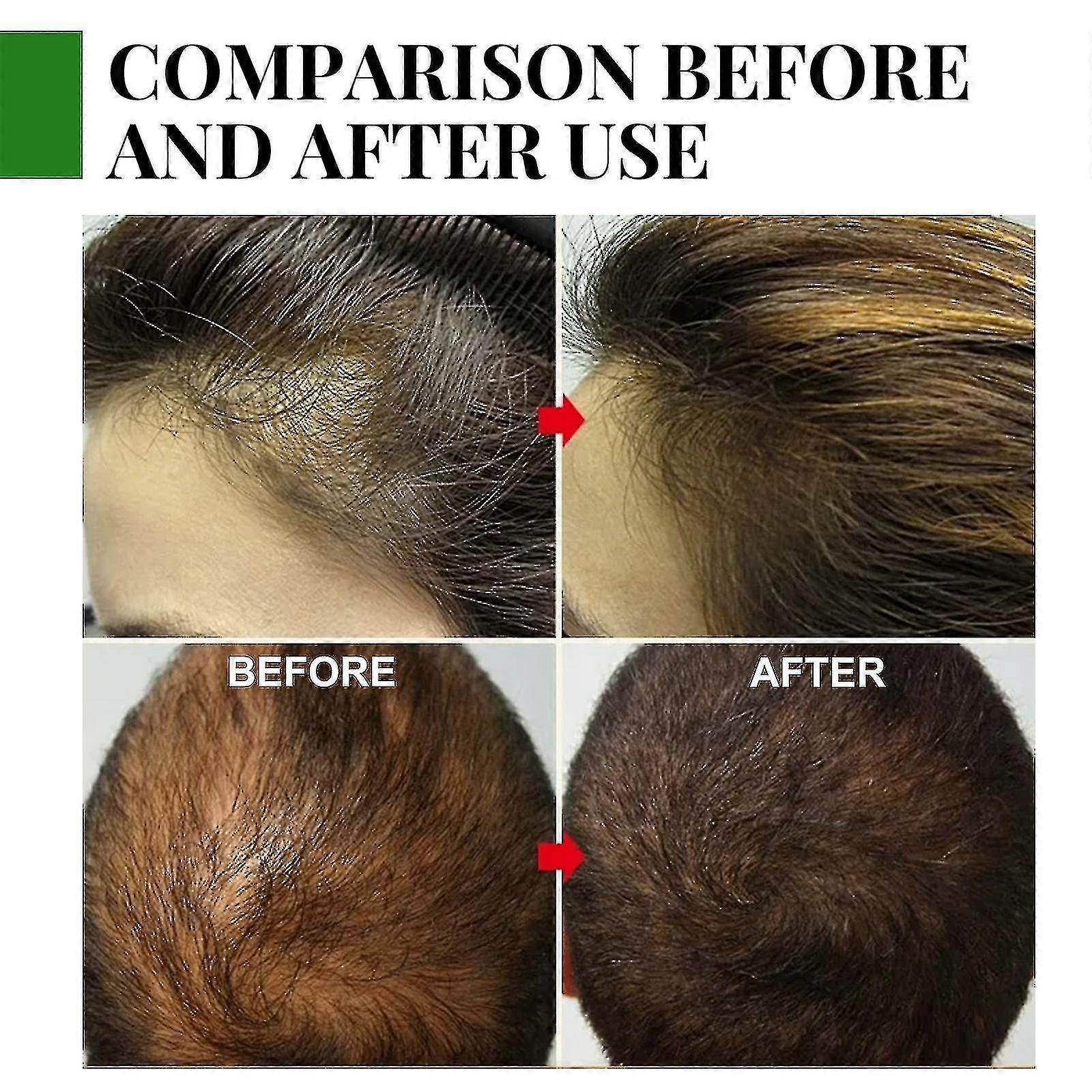 زيت إكليل الجبل Eelhoe يغذي ، يصلح ، يحسن النهايات المتقصفة ، يعتني بالشعر ، يزيل الحكة وفروة الرأس الجافة 30 مل