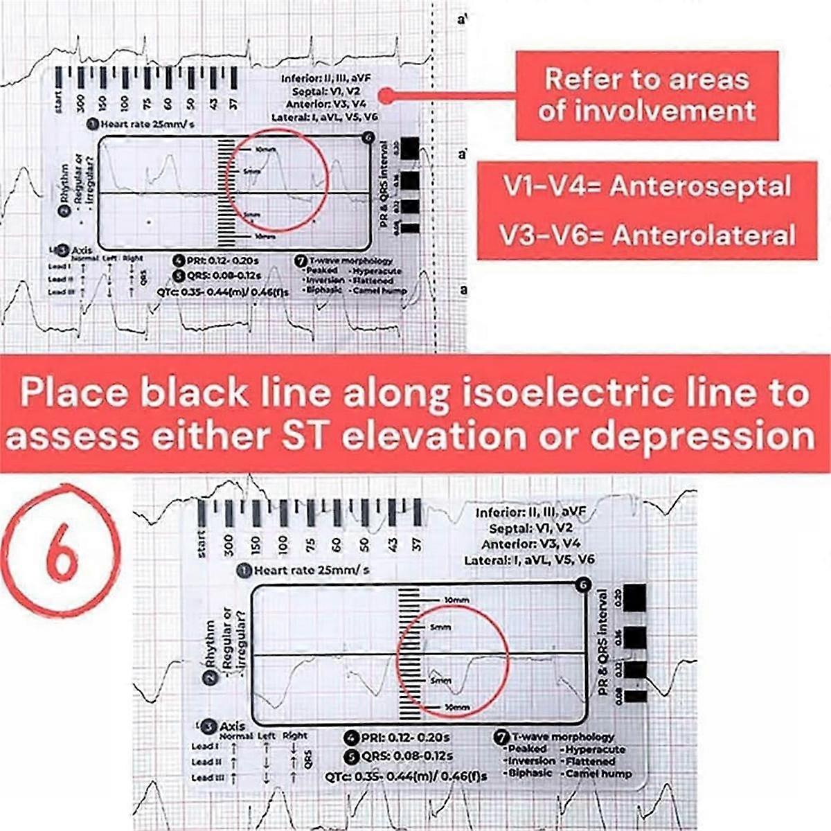 thumbnail image 2 of 2Pcs ECG 7 Step Ruler, ECG Ruler Plastic Ruler Measuring Tool, ECG 7 Step Ruler For ECG/EKG Interpretation, Transparent EKG Calipers Measuring Tool, Follow A 7 Step Plan 2 of 12