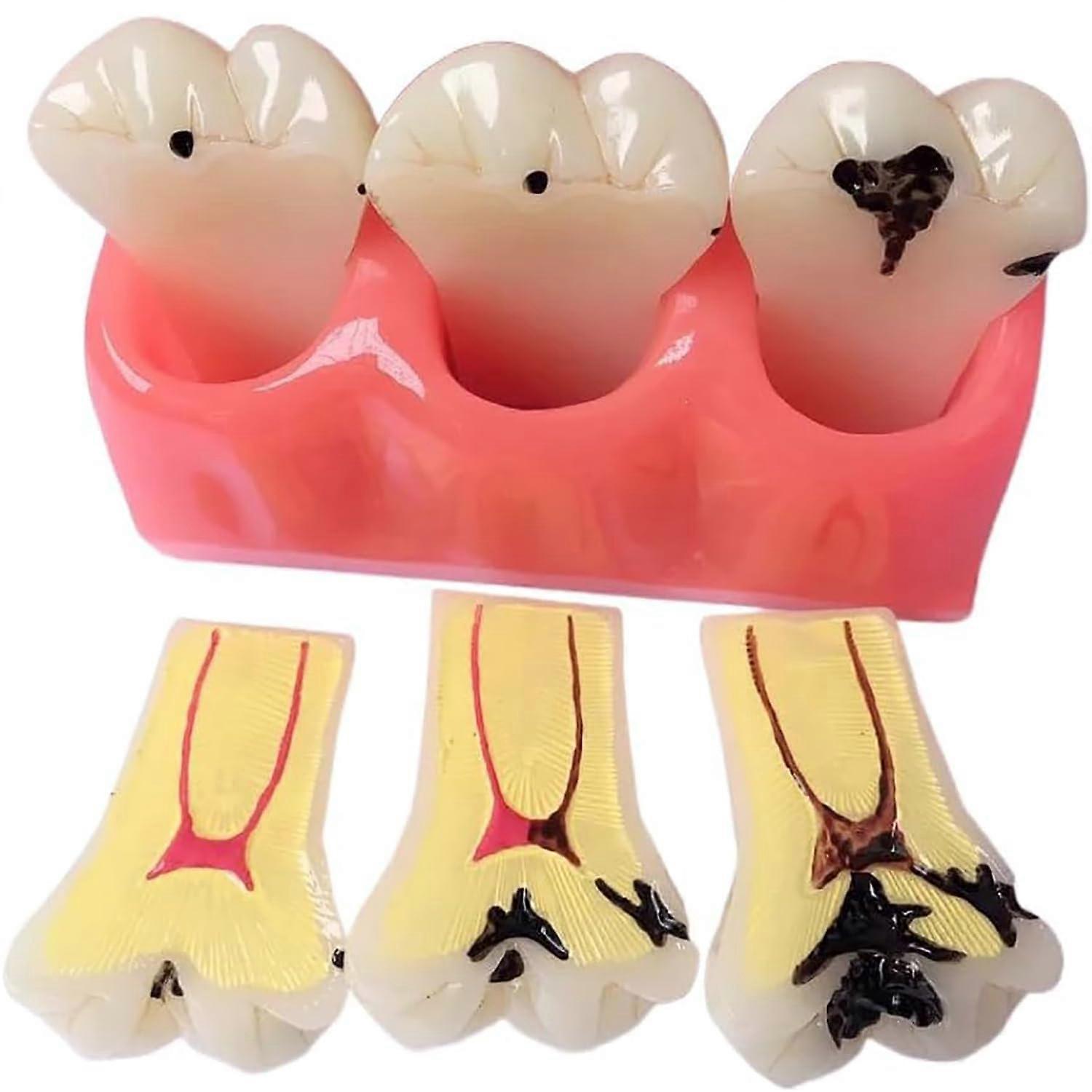 Dental Teeth Model with Removable Teeth Design for Deep Decay Visualization and Teaching Display