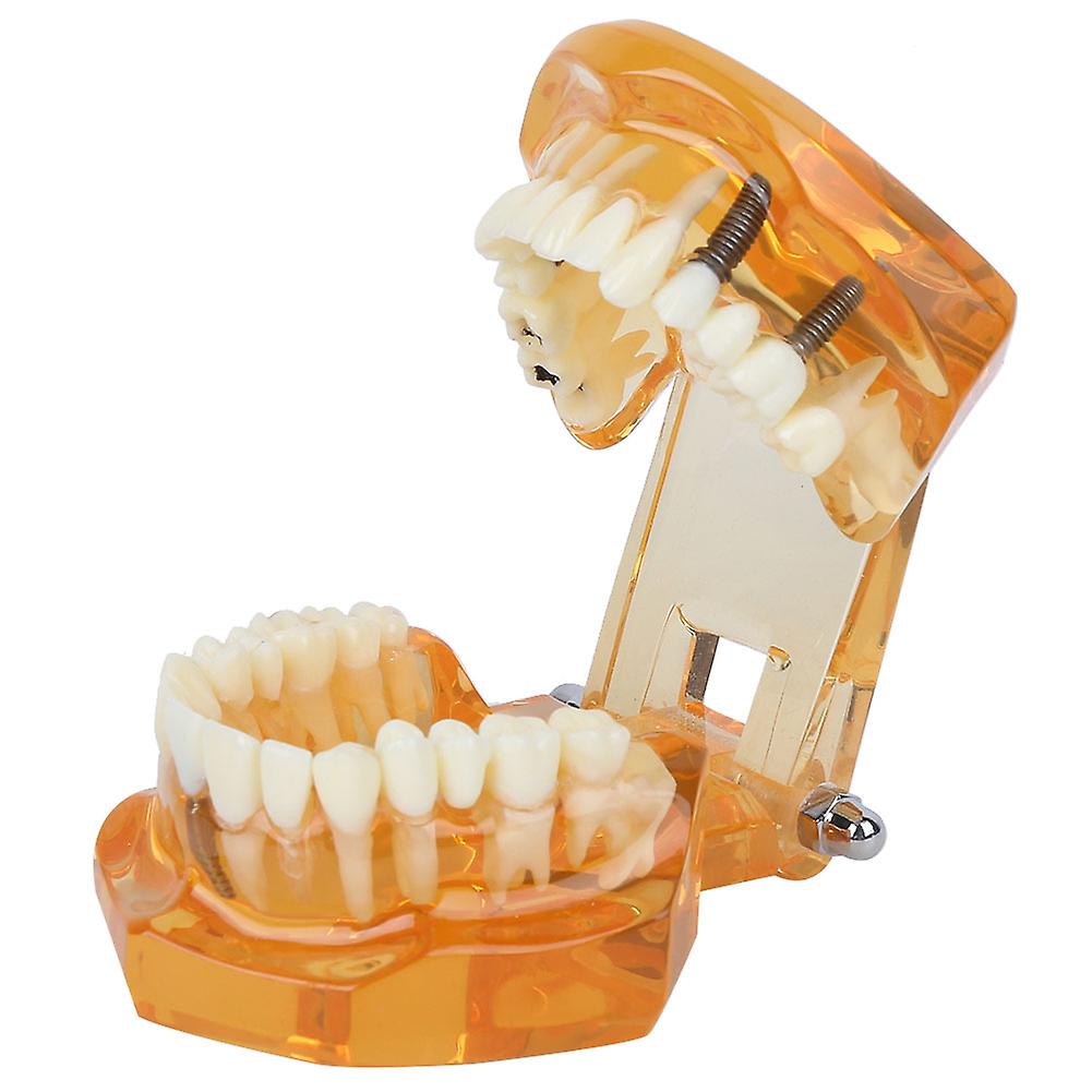 1pc Orange Color Dental Disease Removable Study Teaching Teeth Model