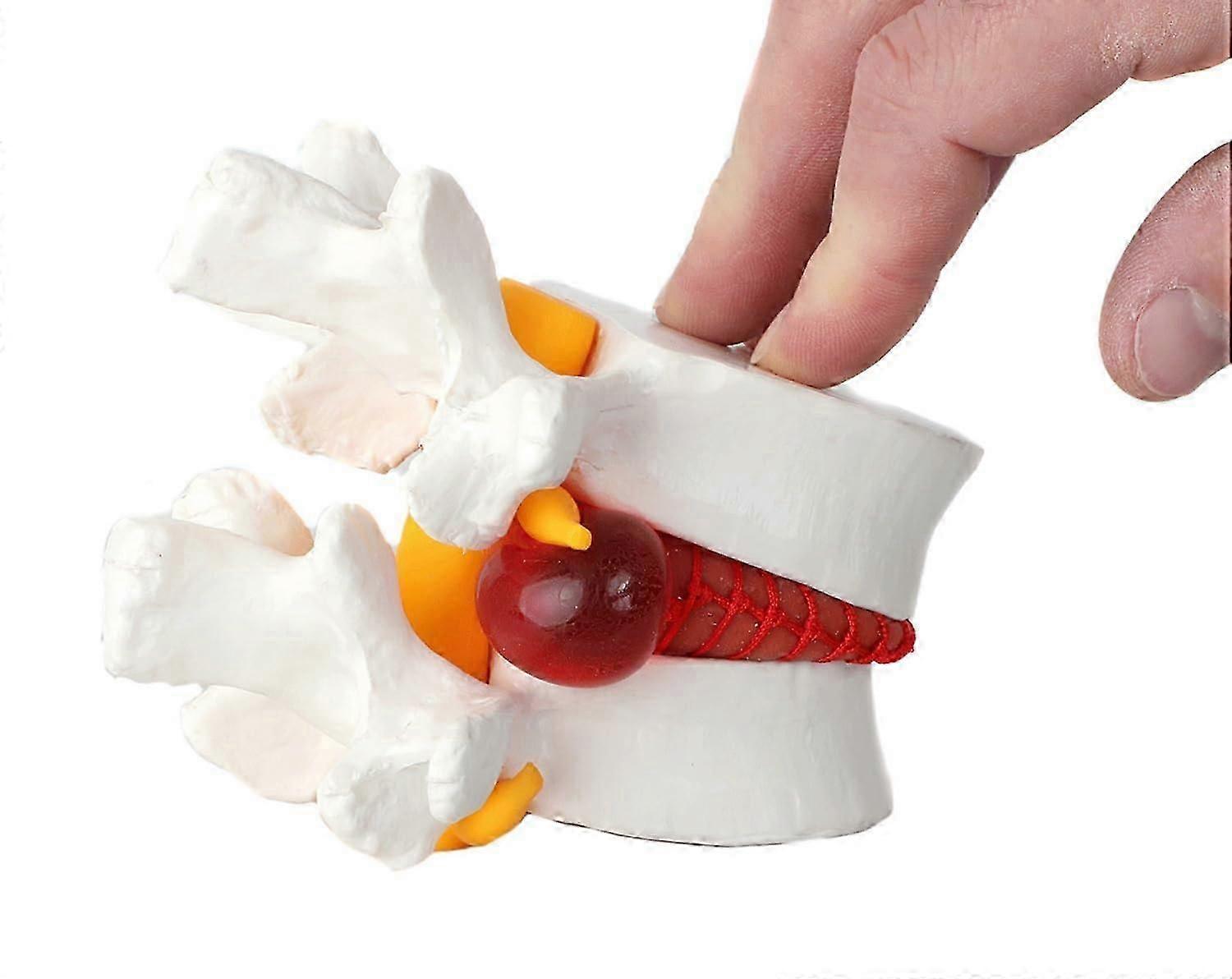 Human Lumbar Herniating Disc Demonstration Anatomy Model for Teaching and Learning