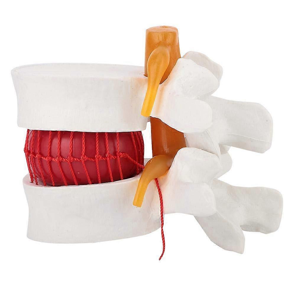 Intervertebral Discs Model 1: 1.5 Human Herniated Disc Model Spine Anatomical Medical Study Demonstration Display Teaching Aid