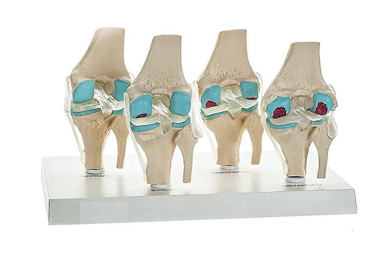 Anatomical Knee Model with FourStage Osteoarthritis Progression and Detailed Visualization on Base