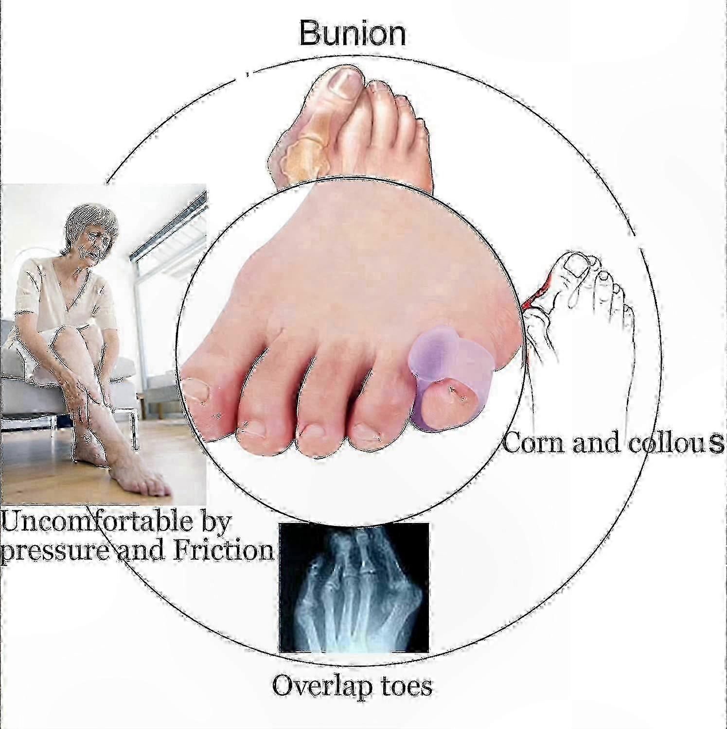 Gel Toe Separators compatible with Little Toe Alignment and Comcompatible witht
