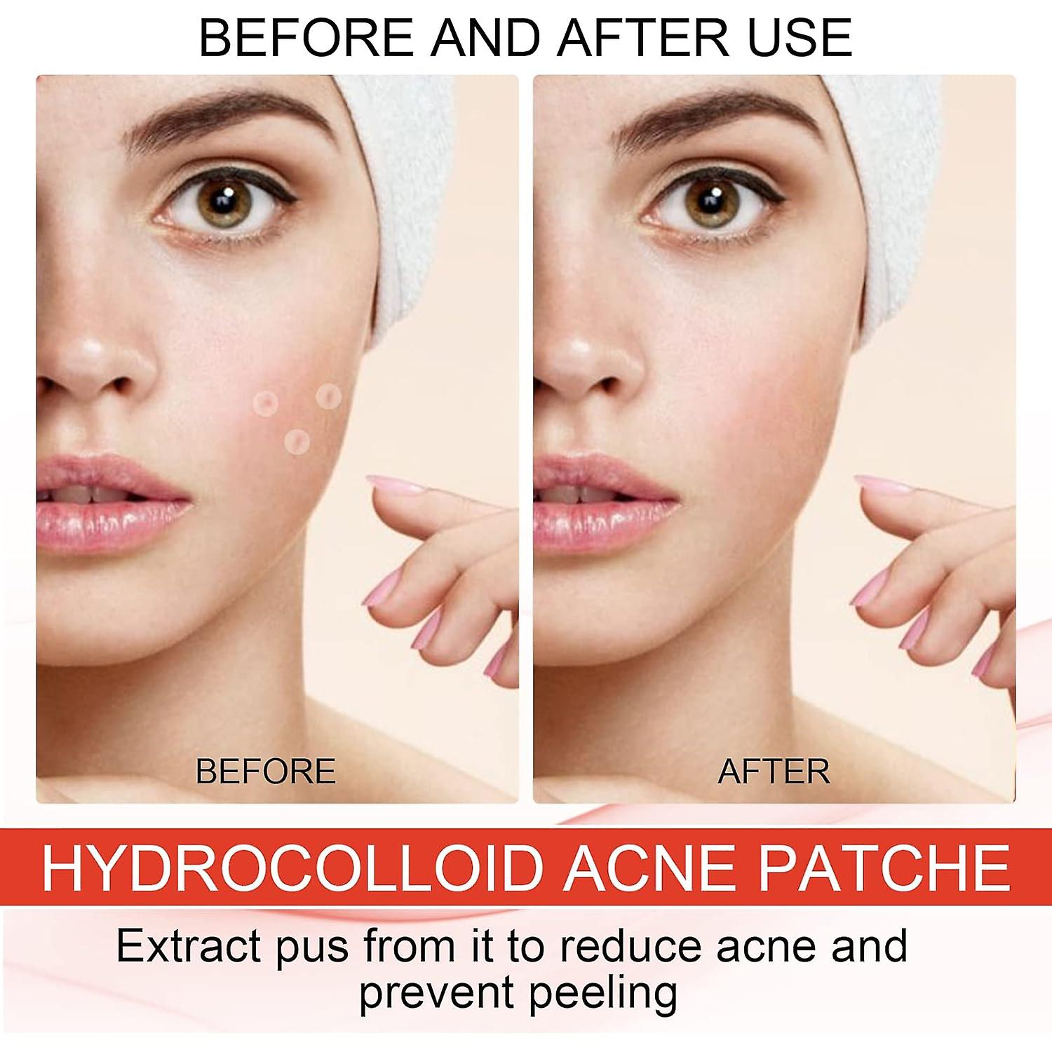 Pimple Patch  Hydrocolloid Plaster for Absorbing Acne Pimples 144Pcs Hydrocolloid Pimple Patch