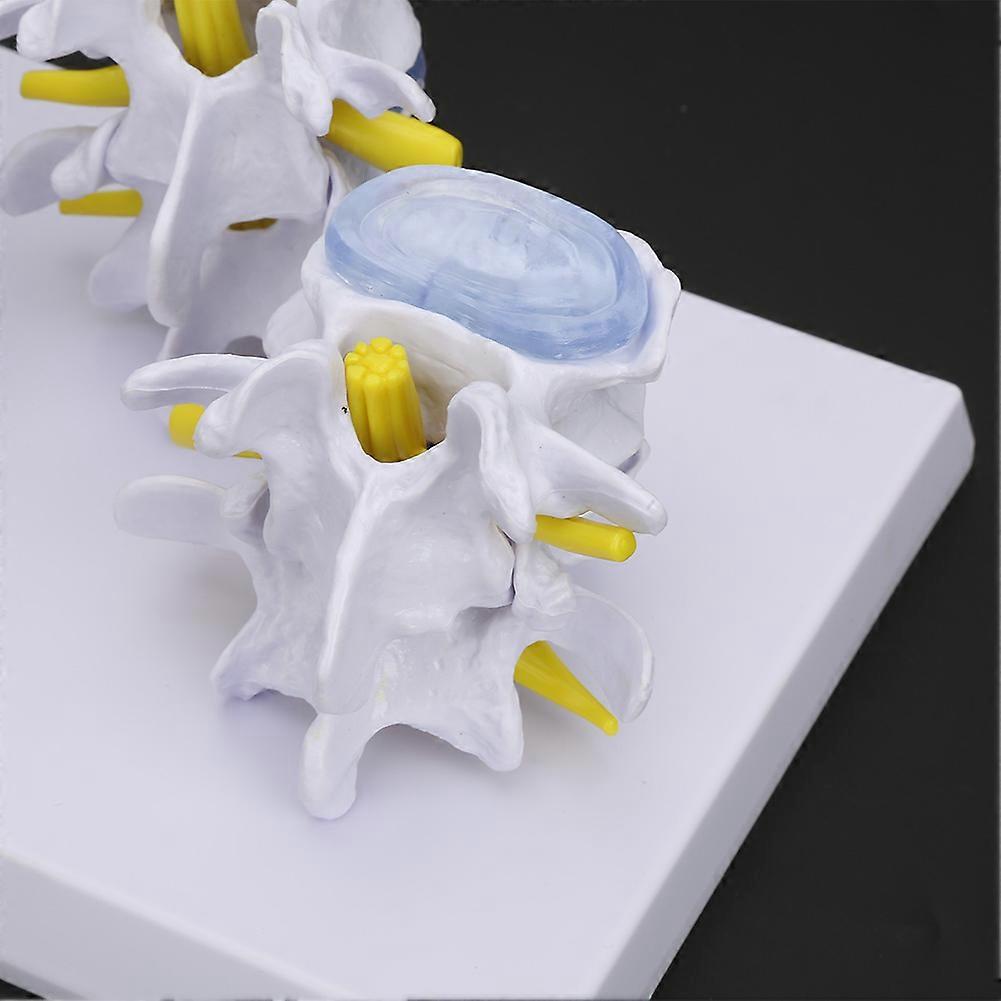4-Stage Medical Lumbar Vertebrae Model, Normal & Pathological PVC