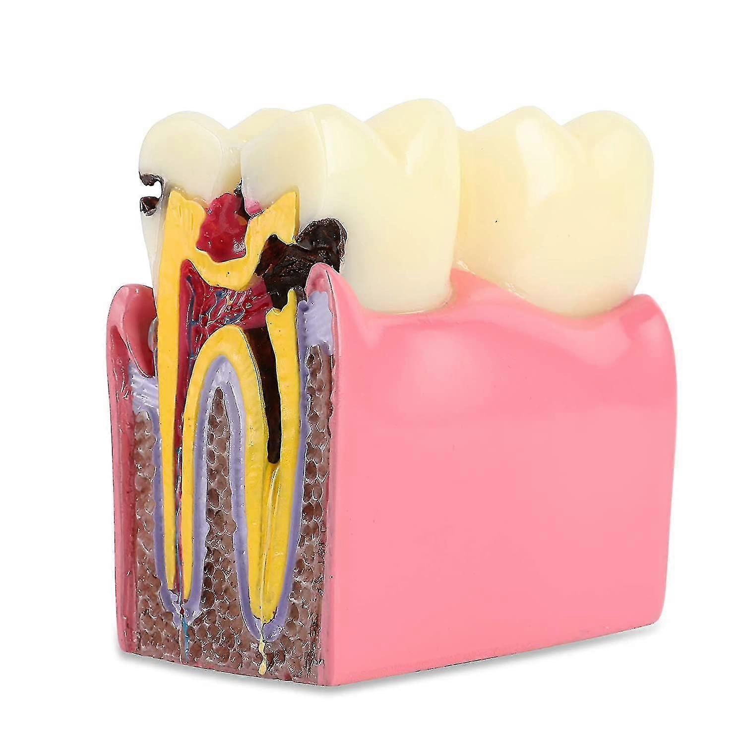Dental Caries Tooth Model 6 Times Decay Teeth Comparative Study Model, Caries Bilateral Comparison Pathology Teeth Model Teaching Learning Tools For D