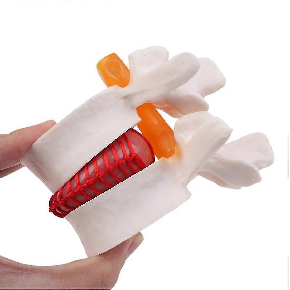 Human Anatomical Lumbar Disc Herniation Model Teaching Model Tool For Medical  Teaching
