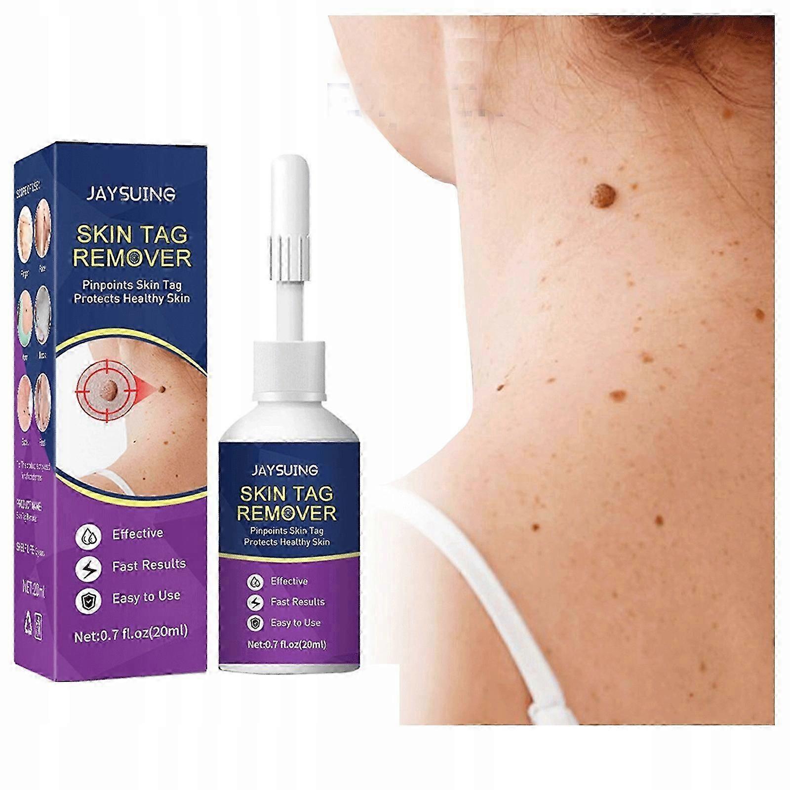 Nipple Crushes, Removes Warts And Chicken