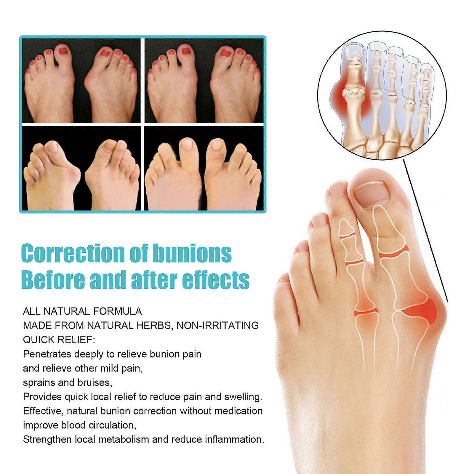 South Moon 8PCS Bunion Patch Relief Bunion Swelling Pain Patch Correction Foot Care Patch