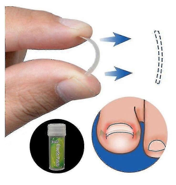 6pcs Ingrown Toenail Straightening Patch Nail Kit