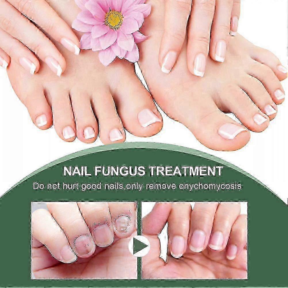 Extra stark nagelsvampbehandling, bsta nagelreparation stoppa svamptillvxt Effectiv