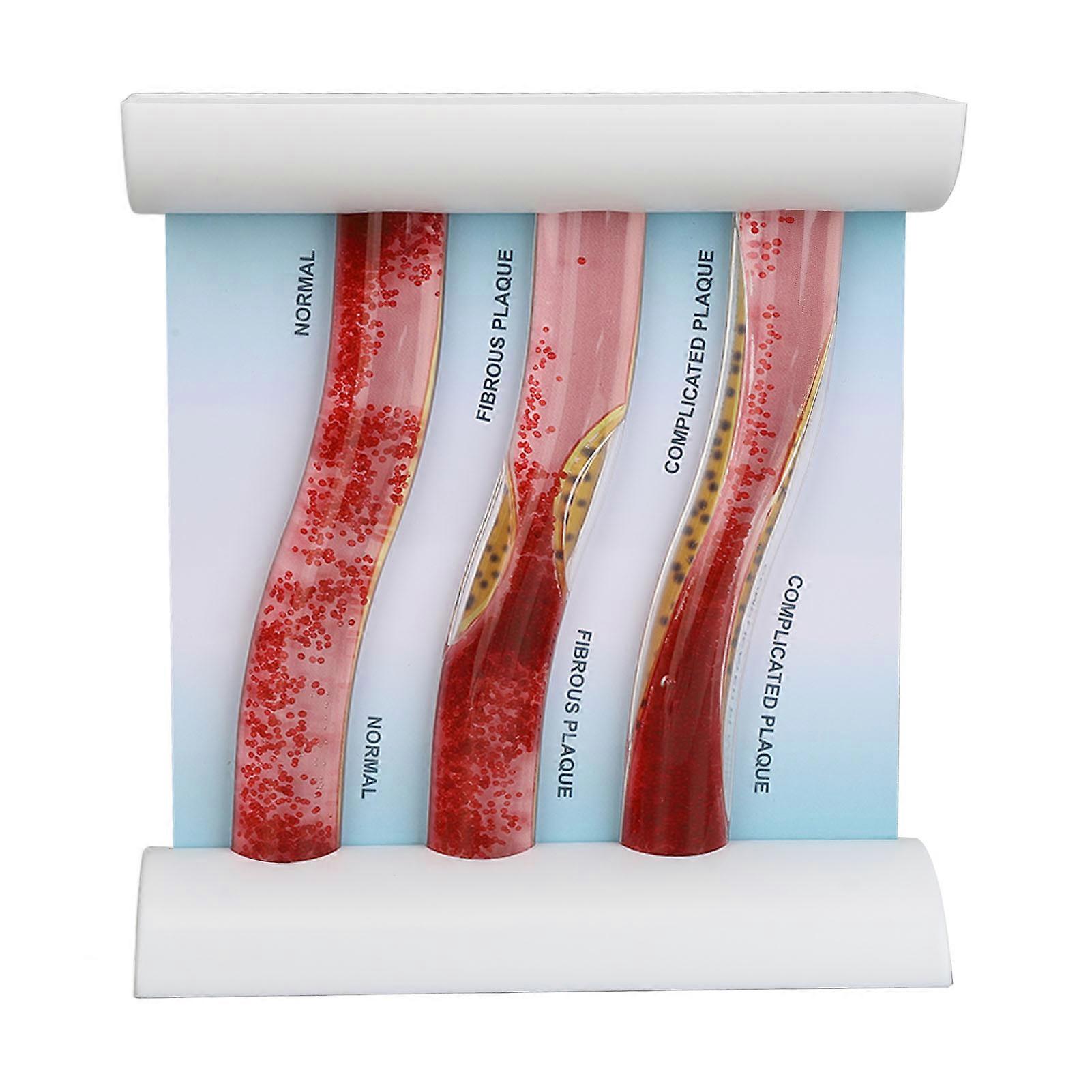 Educational LDL Lipoprotein Model Showing Blood Vessel Blockage