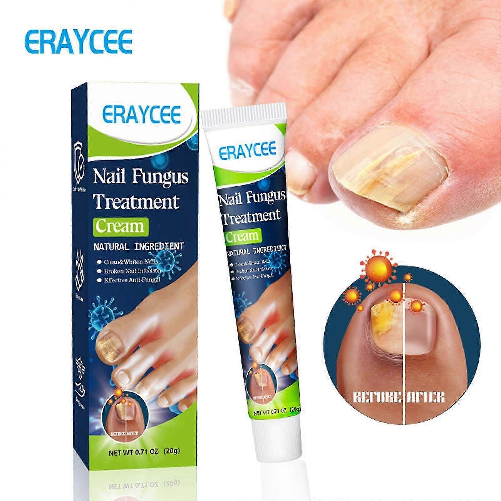 真菌ネイルクリーム、ネイルリペアクリーム、強力な抗真菌足指爪クリーム、ネイルリペア栄養治療、変色して損傷した爪20gを修復します
