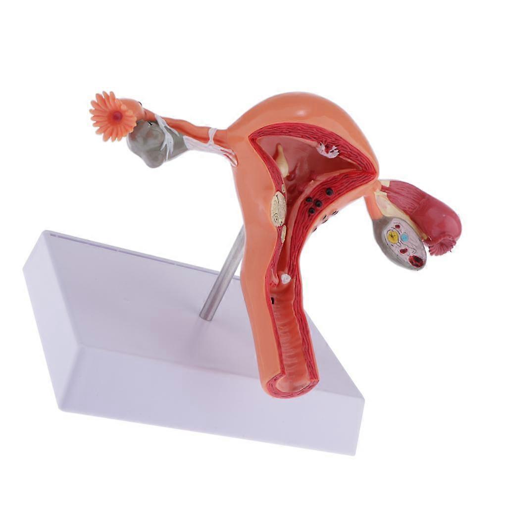 1:1 Human Female Genital System Uterus Ovary Pathological Study Model